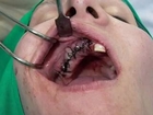 Dr Rodney Aziz - Dental Implants surgery Video